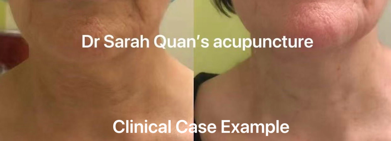Facial Sculpting Acupuncture clinical case example — neck, photo 1