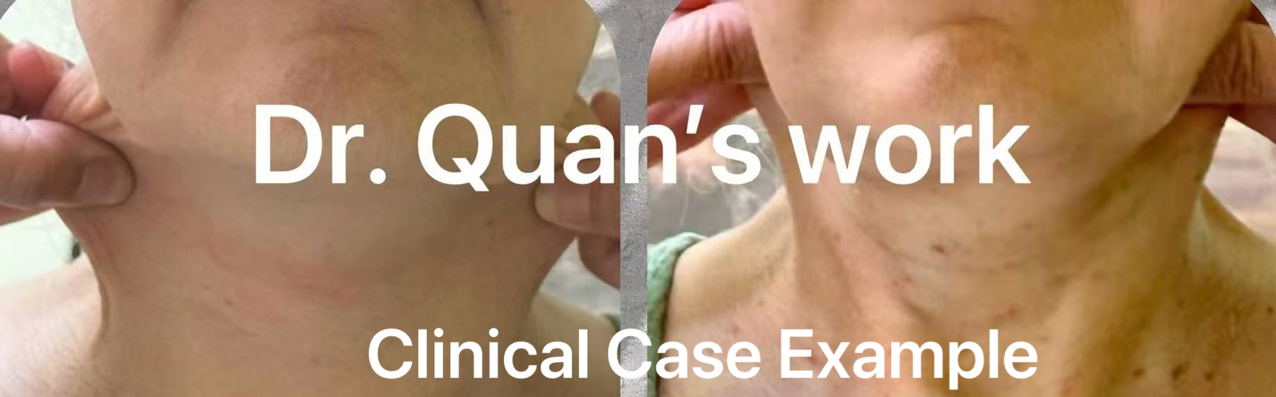 Facial Sculpting Acupuncture clinical case example — neck, photo 2